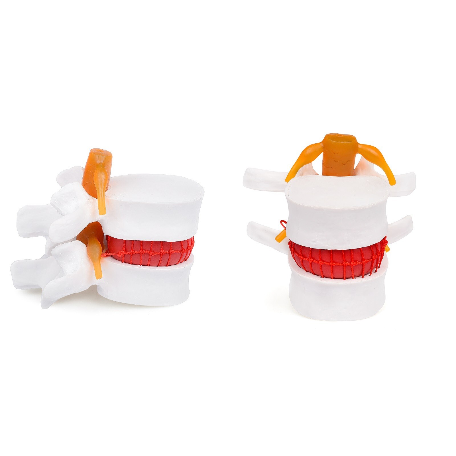 2Pcs Human Anatomy Lumbar Disc Herniation Model Medical Learn Anatomy Instrument