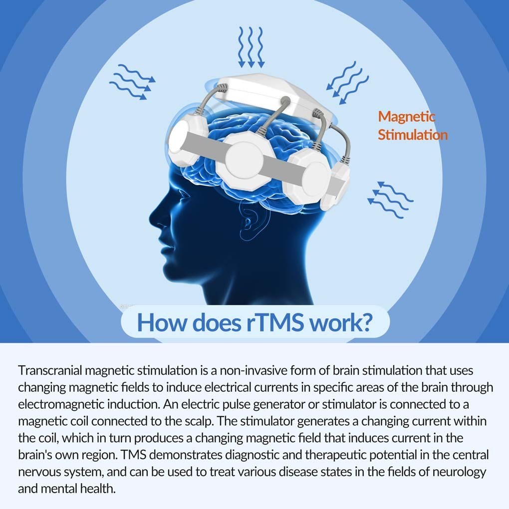 rTMS Transcranial Magnetic Neurostimulation forCognitive Support Mood Regulation