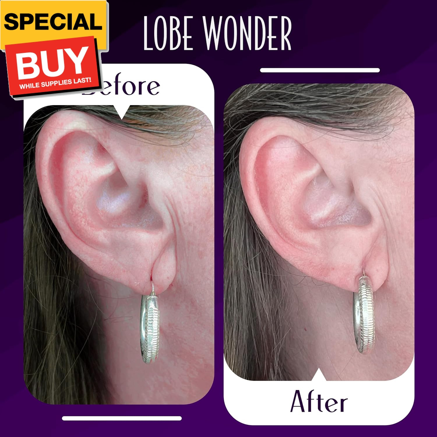 - the ORIGINAL Ear Lobe Support Patch for Pierced Ears - Eliminates