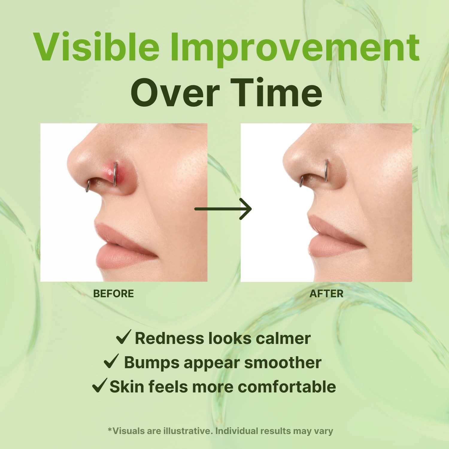 Piercing Bump Solution – Piercing Bump for Ear, Nose & Body – Soothes Keloid ...