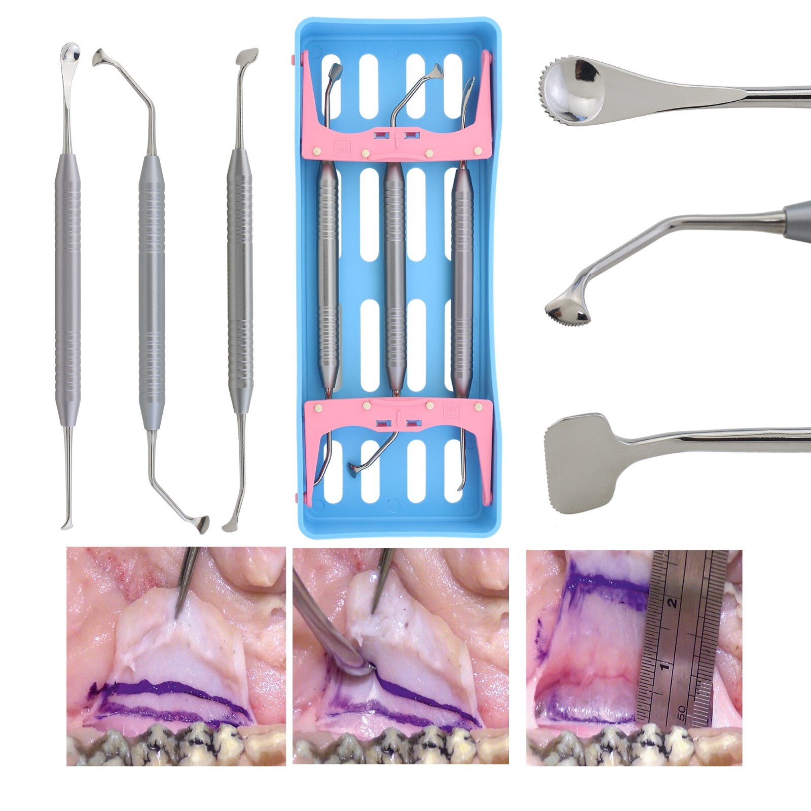 WEN Tension Release Comb Set W-TRC Dental Implant Instruments HELMUT ZEPF Style