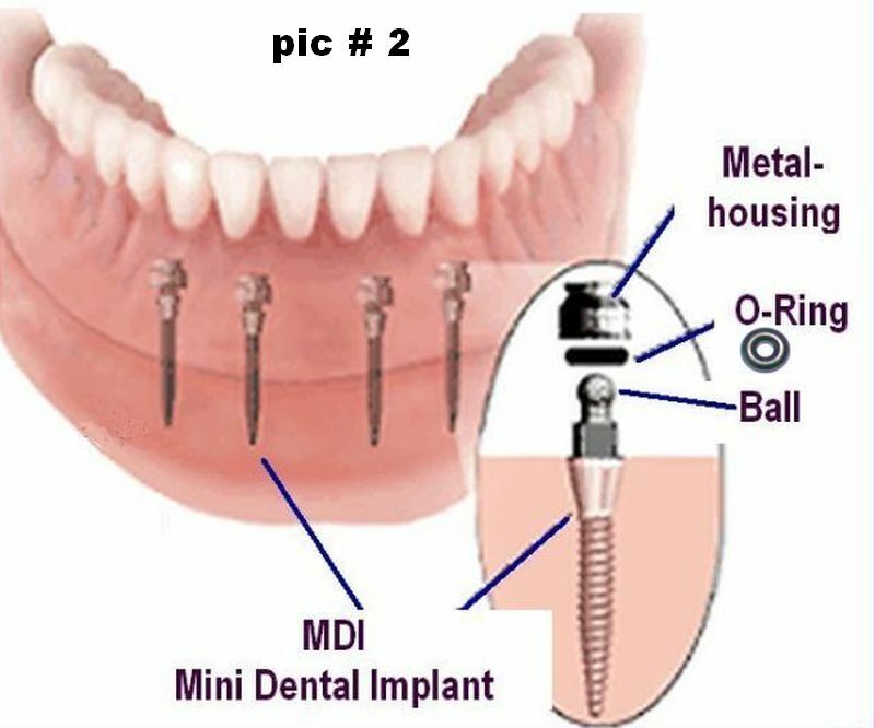 Selection of 3 sizes rubber o-rings replacement for Micro Mini Dental Implants