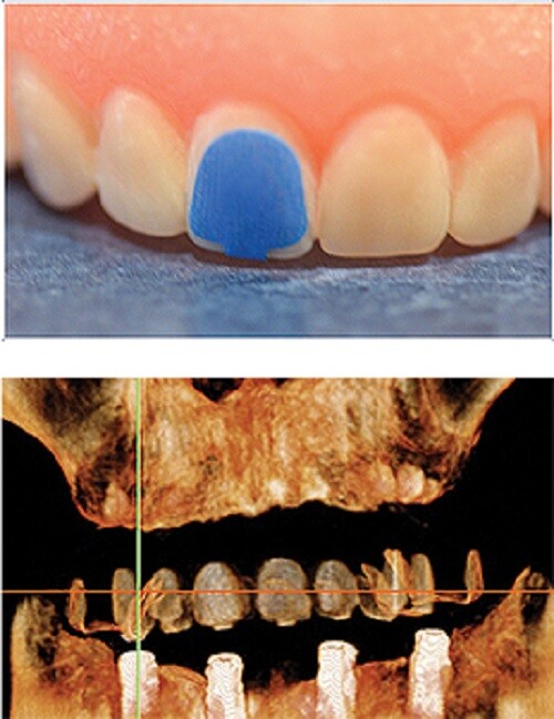 Denture Cone Beam Skin Markers, 9 Styles