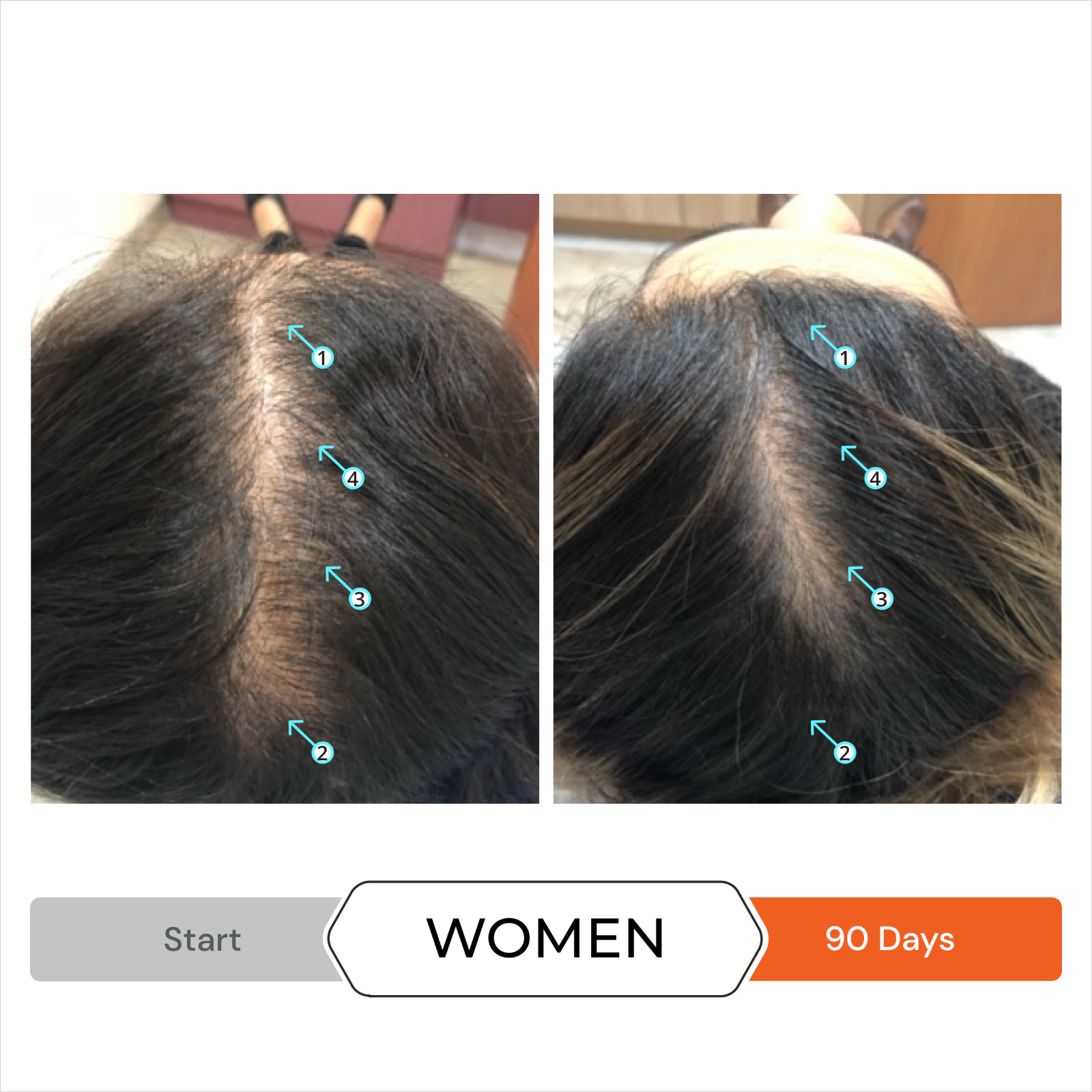 Revita | GUMMIES FOR HAIR GROWTH SUPPORT