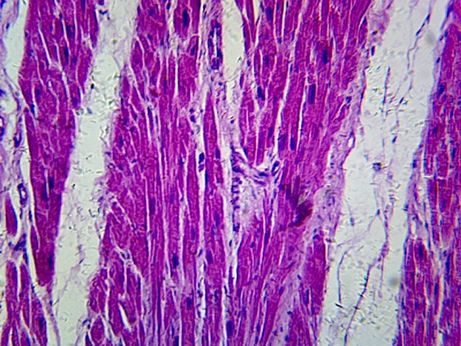 Myocardial Infarction; Section; H&E Stain; Showing Damaged Muscle
