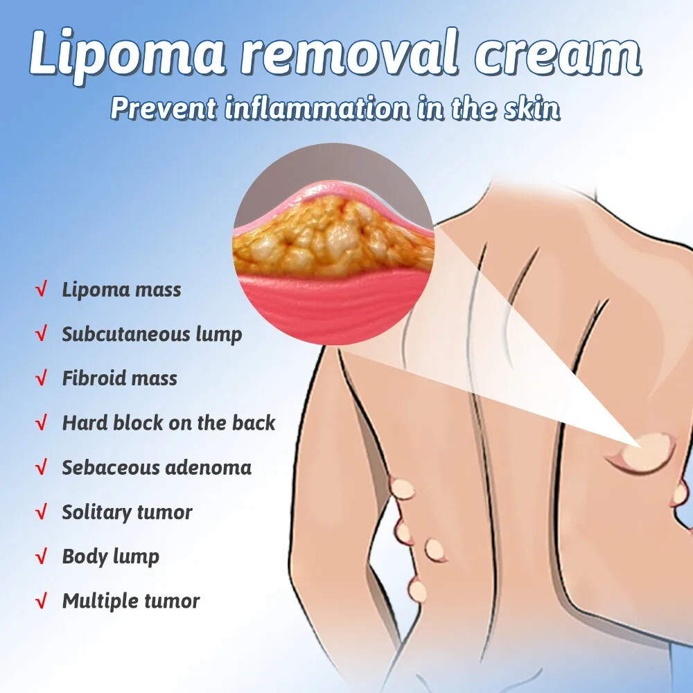 2PCS Lipomheilung Reduction Spray, Instant LumpFree Lipoma Removal Spray USA Hot