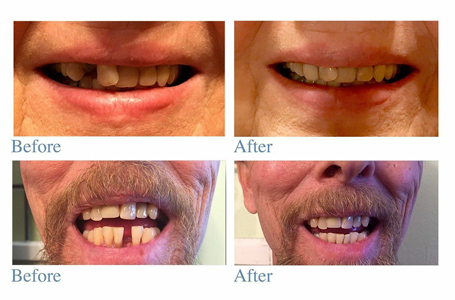 Instant Smile Emergency Temporary Tooth Replacement Kit Teeth